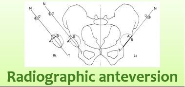 Radiographic Anteversion